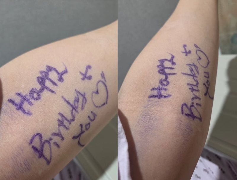 수술 후 A씨의 팔에 남아 있던 ‘Happy Birthday to you♡’ 생일 축하 문구. [사진제공 A씨 스레드 캡처]